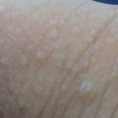 病毒疣尤治療注意事項(xiàng)