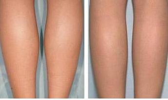 脂肪豐胸術(shù)后注意事項,脂肪填充術(shù)后注意事項,面部脂肪填充術(shù)后注意事項