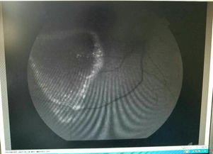 造影,眼科,注意事項(xiàng)