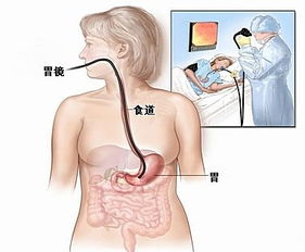 腸鏡后的飲食注意事項(xiàng)