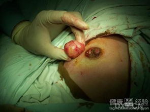 乳腺纖維瘤拆線后注意事項,乳腺纖維瘤切除術后注意事項,乳腺纖維瘤手術后注意事項及飲食