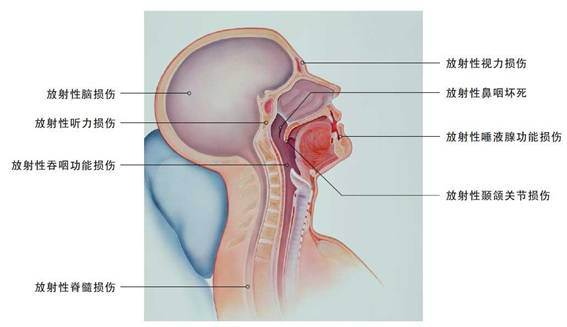 鼻咽癌,放療,麻醉,注意事項