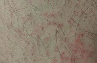 毛囊炎與疥瘡的注意事項