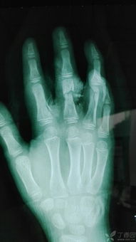 淚管吻合術后注意事項