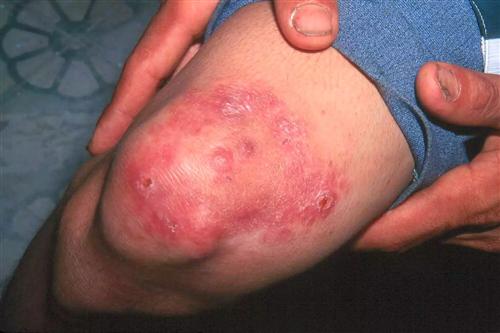 麻風(fēng),麻疹,疫苗,注意事項(xiàng)