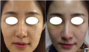 埋線拉皮后注意事項