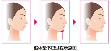 假體下巴做完后的注意事項(xiàng),假體下巴術(shù)后注意事項(xiàng),假體下巴飲食注意事項(xiàng)