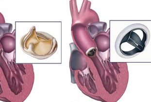 二尖瓣置換術(shù)后注意事項