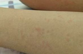 變應(yīng)性蕁麻疹注意事項(xiàng)