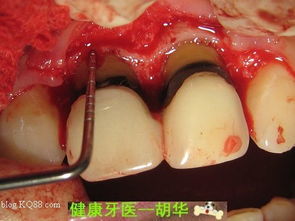 牙冠延長(zhǎng)手術(shù)后注意事項(xiàng)