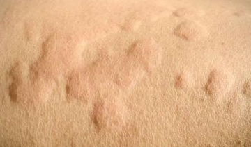 玫瑰糠疹洗澡注意事項