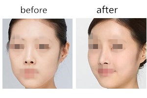 鼻孔縮小手術(shù)注意事項(xiàng)