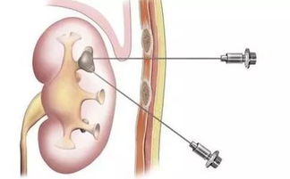 活檢,注意事項(xiàng)