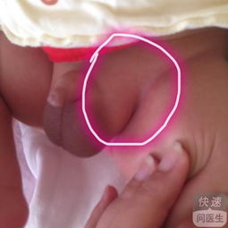 疝氣全麻手術(shù)后注意事項,小孩疝氣手術(shù)后注意事項8大要點要謹記,腹腔鏡疝氣手術(shù)后注意事項