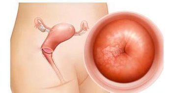 宮頸糜爛日常注意事項