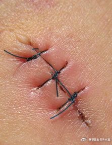 寶寶摔傷縫針注意事項