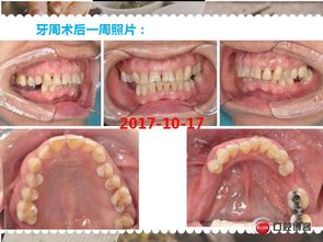 牙周病,書寫,注意事項(xiàng)