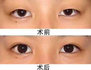 眼睛矯正后注意事項