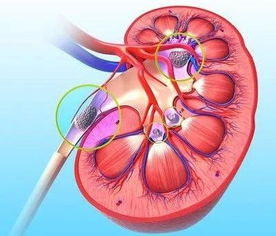 腎結(jié)石,患有,需注意,事項(xiàng)