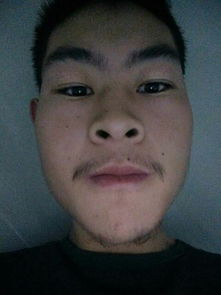 臉部祛痣后注意事項,臉部手術切痣后注意事項,取了痣的注意事項