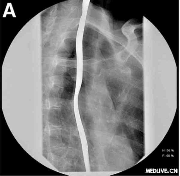 眼睛造影后注意事項(xiàng)