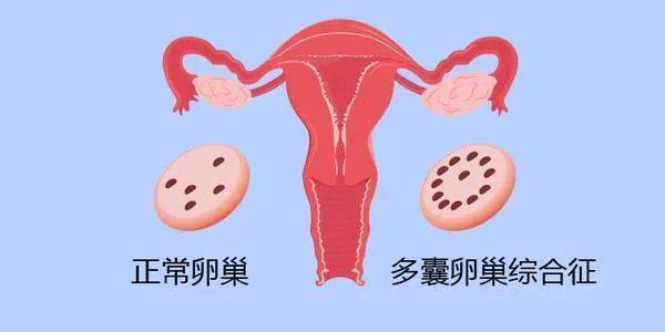 多囊卵巢孕婦注意事項