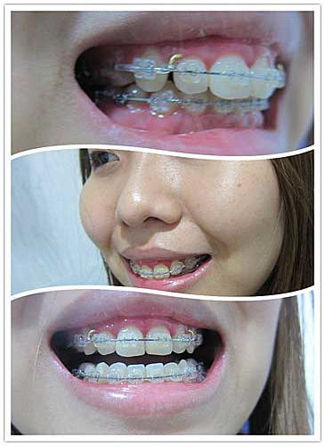 補牙牙套后注意事項