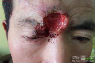 基底細(xì)胞癌術(shù)后飲食注意,基底細(xì)胞癌術(shù)后復(fù)查什么項(xiàng)目,基底細(xì)胞癌術(shù)后護(hù)理