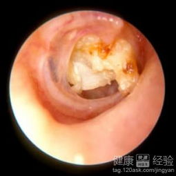 服用利福平注意事項(xiàng)