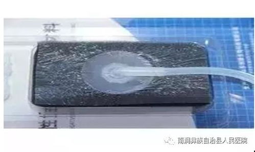 vsd負壓吸引術的注意事項,vsd負壓吸引的目的及注意事項,vsd負壓沖洗的注意事項