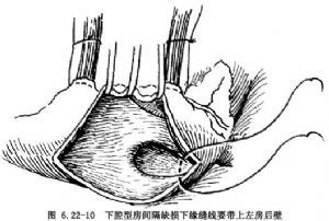 房間隔缺損手術(shù)注意事項(xiàng)