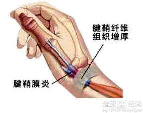 腱鞘炎打針后注意事項