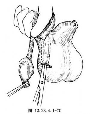 睪丸固定術(shù)術(shù)后注意事項(xiàng)