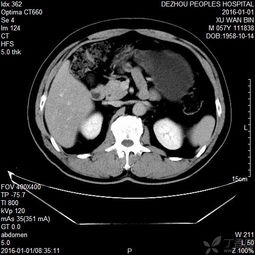胰腺查血注意事項