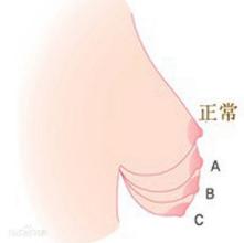 乳房下垂矯正后注意事項