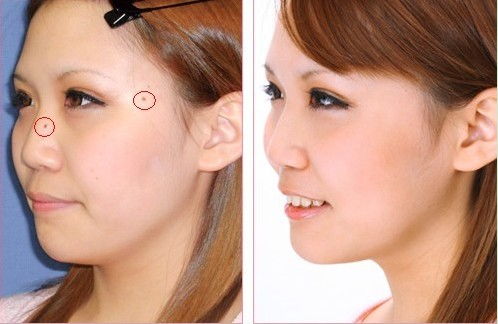 二氧化碳激光去痣后注意事項