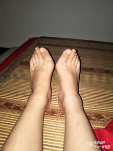 做完拇指外翻手術(shù)后應(yīng)注意事項(xiàng)