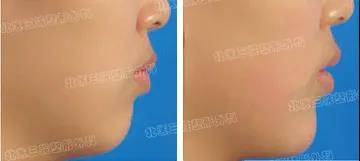 隆下頦后注意事項藝星