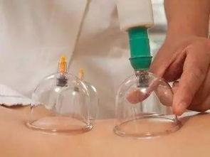 理療,注意事項,拔罐