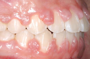 補牙戴牙套后注意事項,補牙后裝牙套后有什么注意事項,補牙后的注意事項