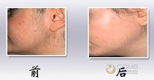 激光,注意事項,脫臉毛后