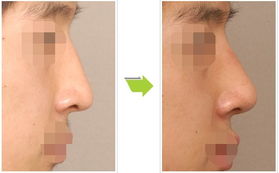 整形,注意事項(xiàng)