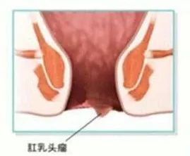 肛乳頭肥大結(jié)扎術(shù)后注意事項