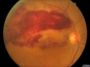 做眼底檢查時病人注意事項(xiàng)