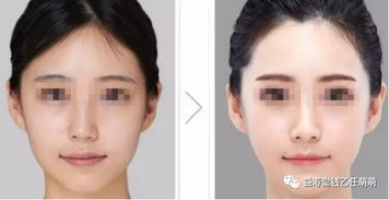 注射,注意事項(xiàng),自體,美容