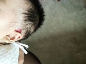 激光血管痣后注意事項(xiàng)