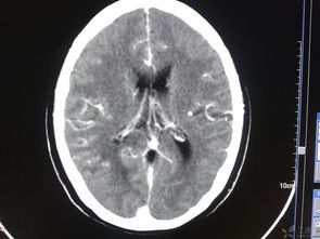 腦部腫瘤飲食注意事項,腦部出血飲食注意事項,腦部缺血灶飲食注意事項