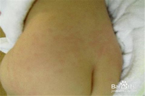 小兒病毒疹子注意事項