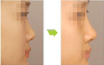 鼻整形一周注意事項(xiàng)