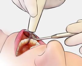 開刀拔智齒后注意事項(xiàng)